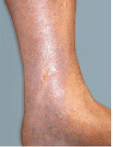 diabetic foot ulcer Before & After Pictures Addison, TX