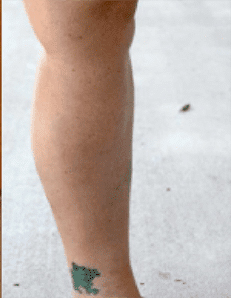 Varicose Vein Before and After Pictures Dallas, TX