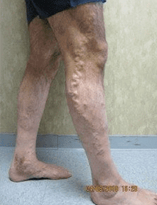 Varicose Vein Before and After Pictures Dallas, TX