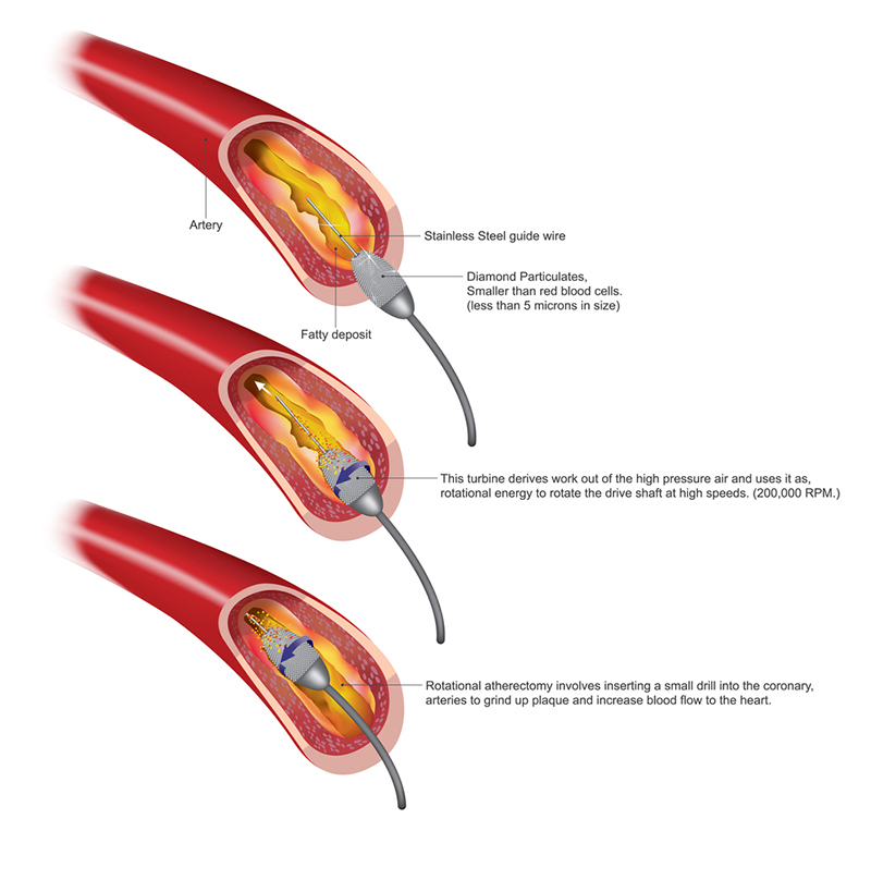 Atherectomy in Dallas