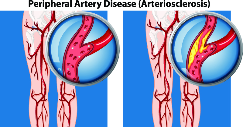 Peripheral Arterial Disease in Dallas