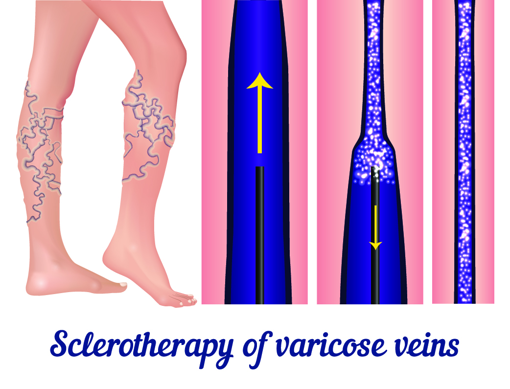 Sclerotherapy in Dallas