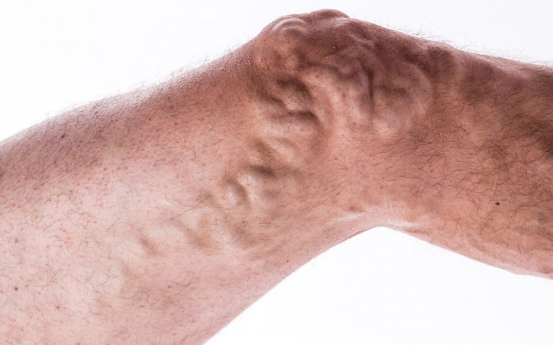 3 Ways to Treat Varicose Veins Without Surgery - StrideCare