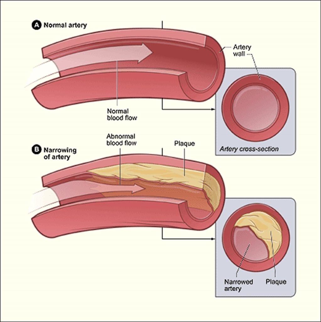 peripheral arterial disease myths normal vs diseased artery