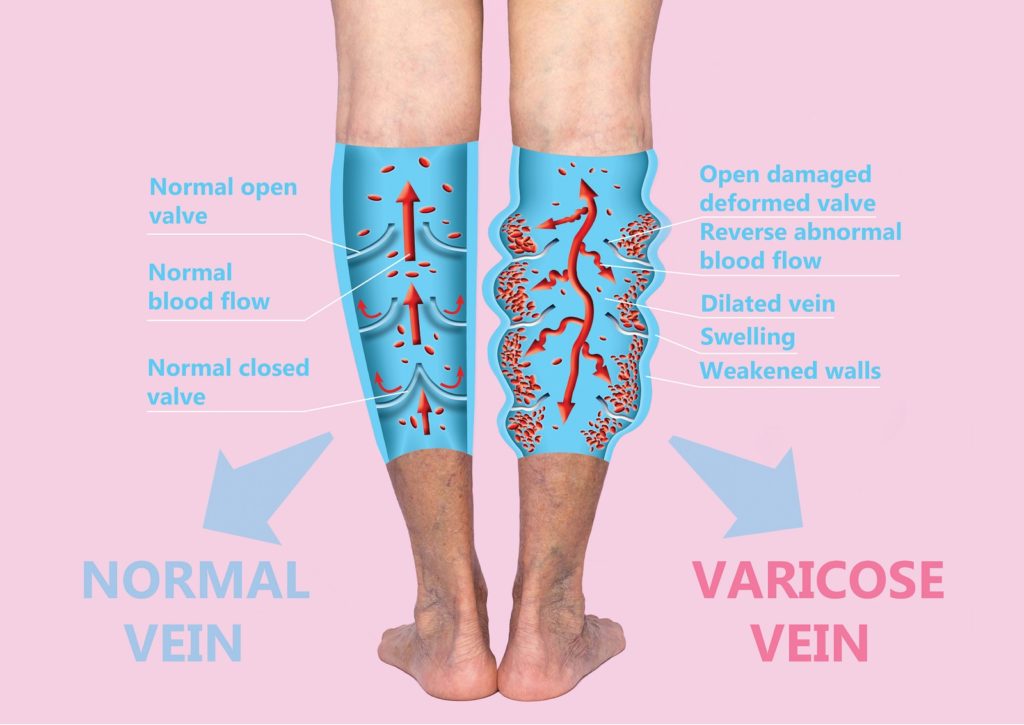 varicose vein symptoms