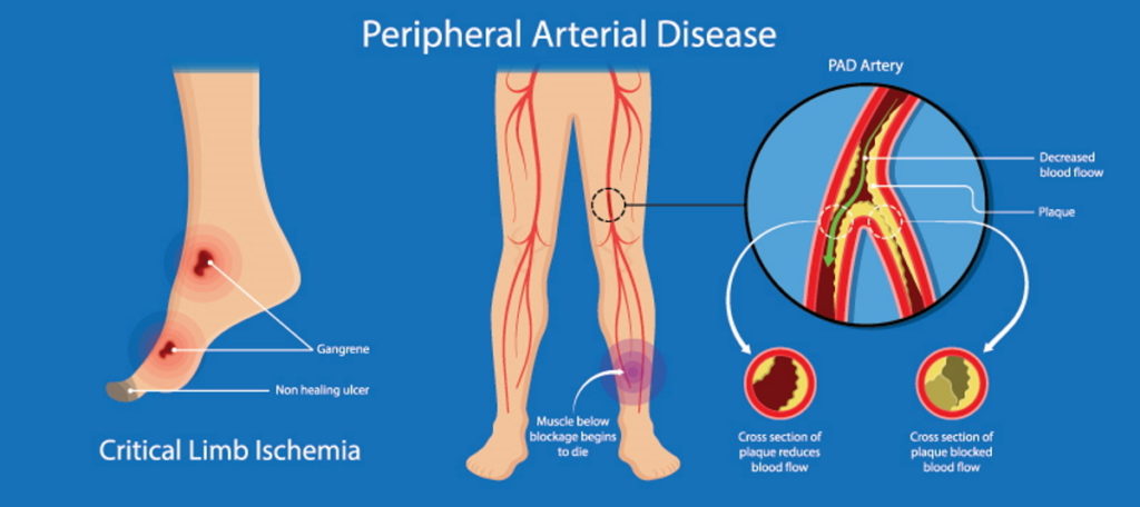 Peripheral Artery Disease PAD illustration