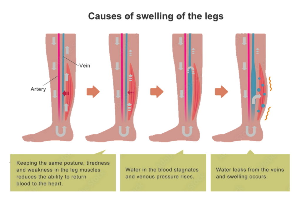 Smerig Politiek in tegenstelling tot Signs of Edema: How To Reduce Leg Swelling - Precision Vascular