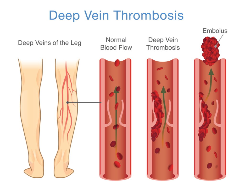 Deep Vein Thrombosis DVT