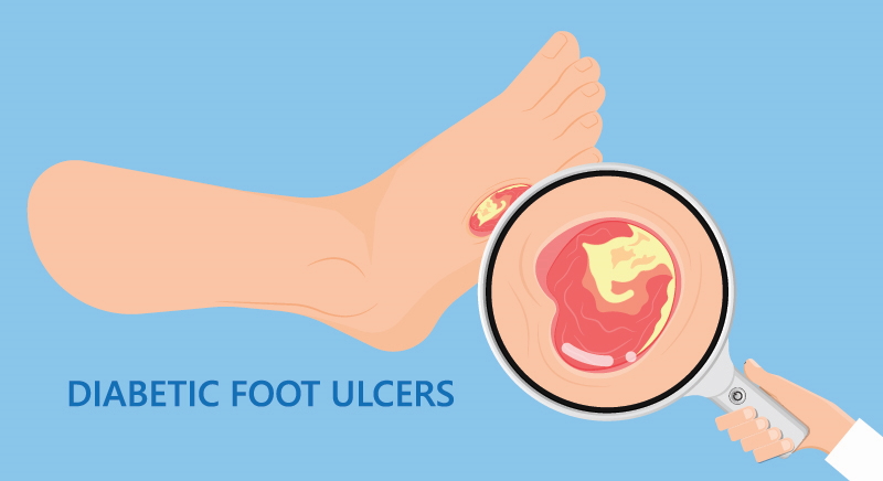 Diabetic Vascular Disease Foot Ulcer