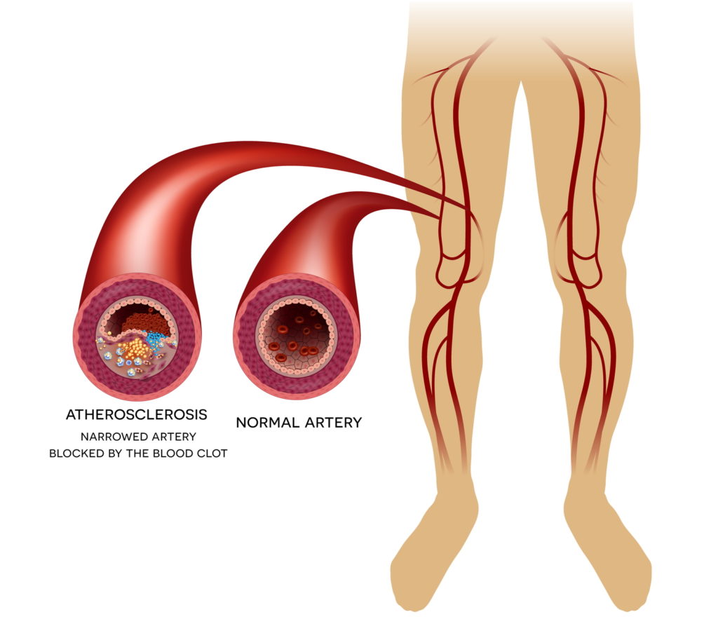 numbness in feet and legs PAD leg artery disease atherosclerosis