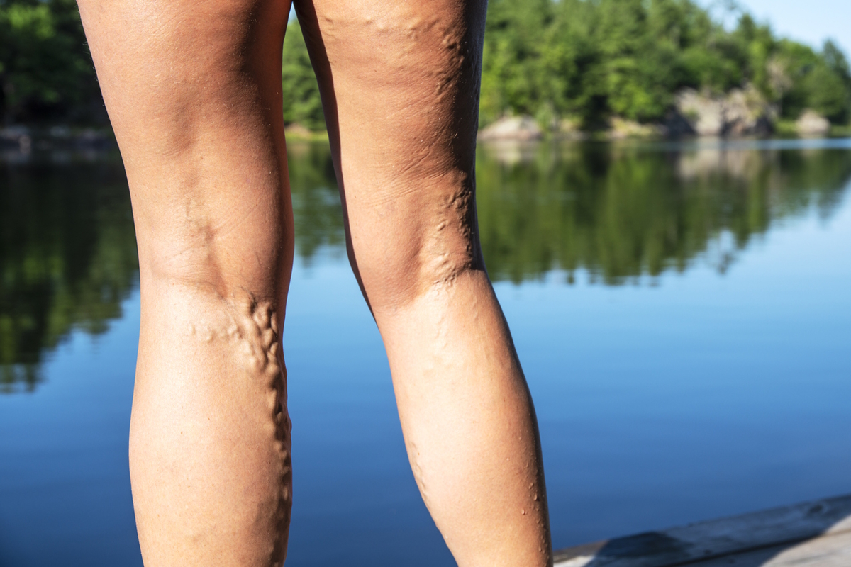 varicose veins on woman legs