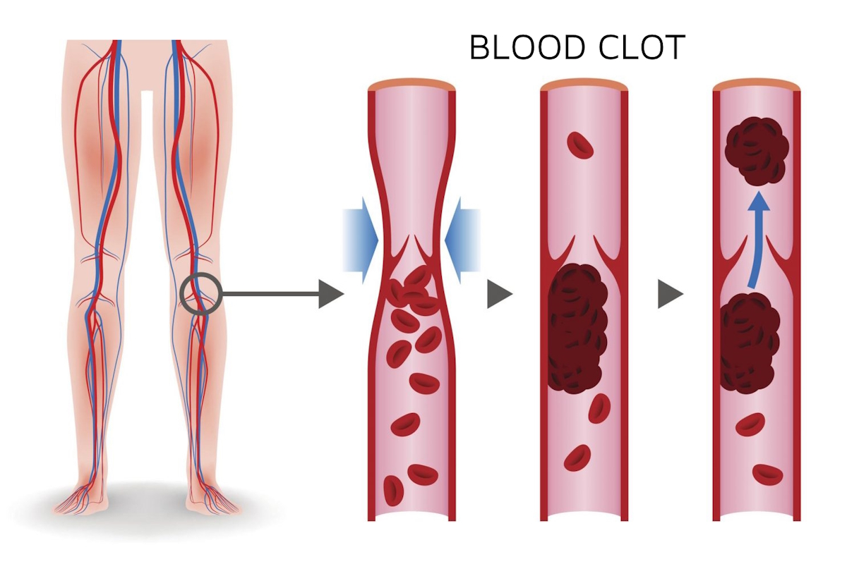 vein thrombosis blood clot