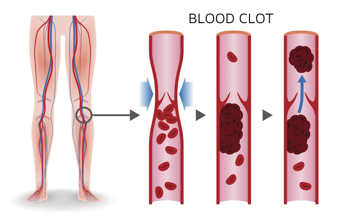 leg swelling blood clot deep vein thrombosis