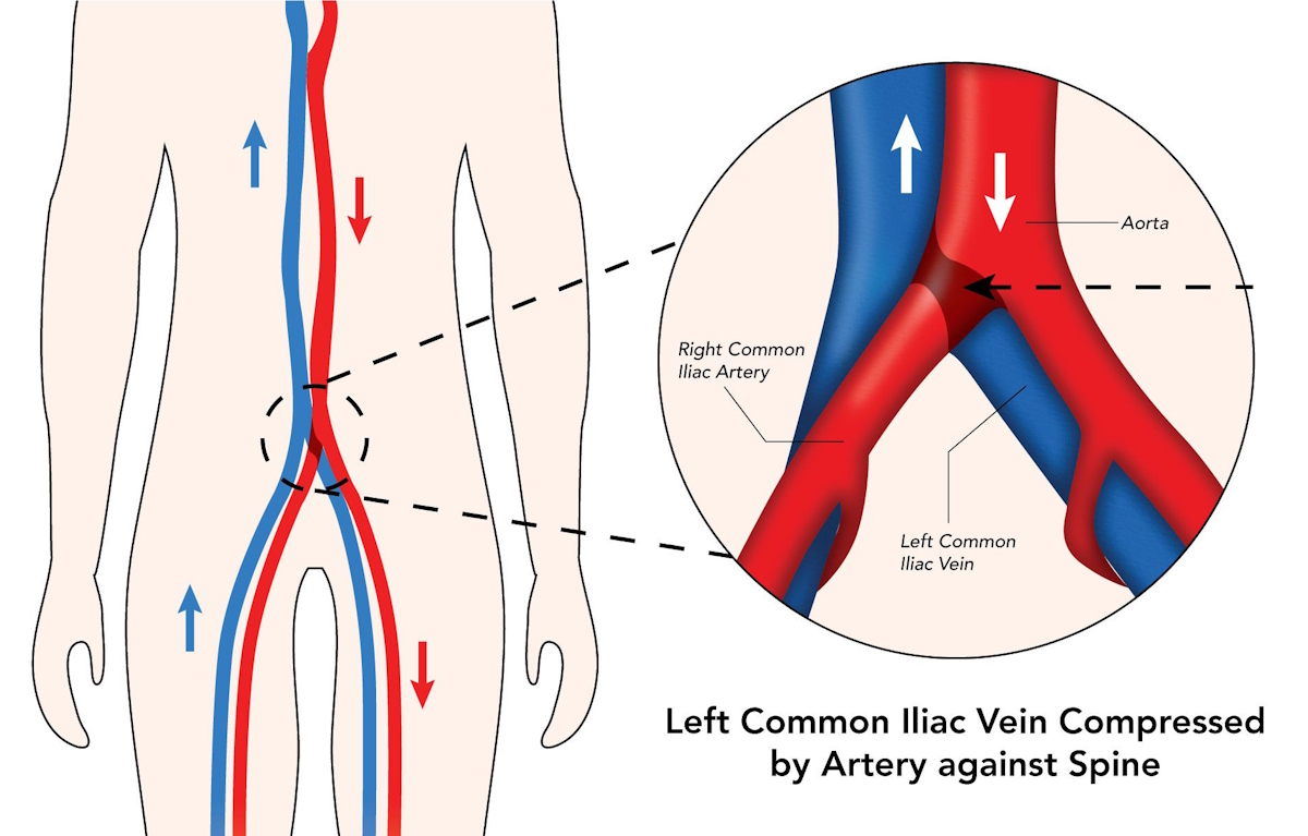 leg swelling illustration iliac vein compression