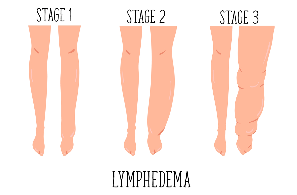 leg swelling lymphedema illustration