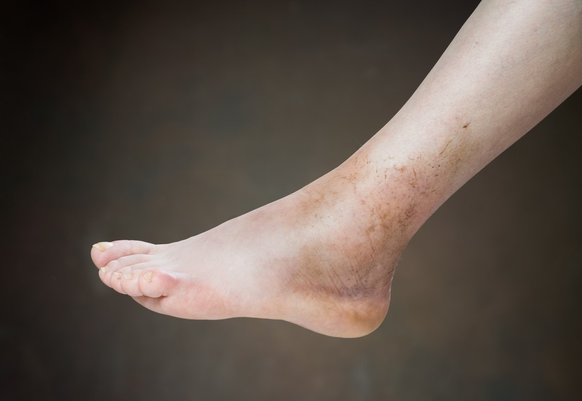 vein disease swelling discoloration