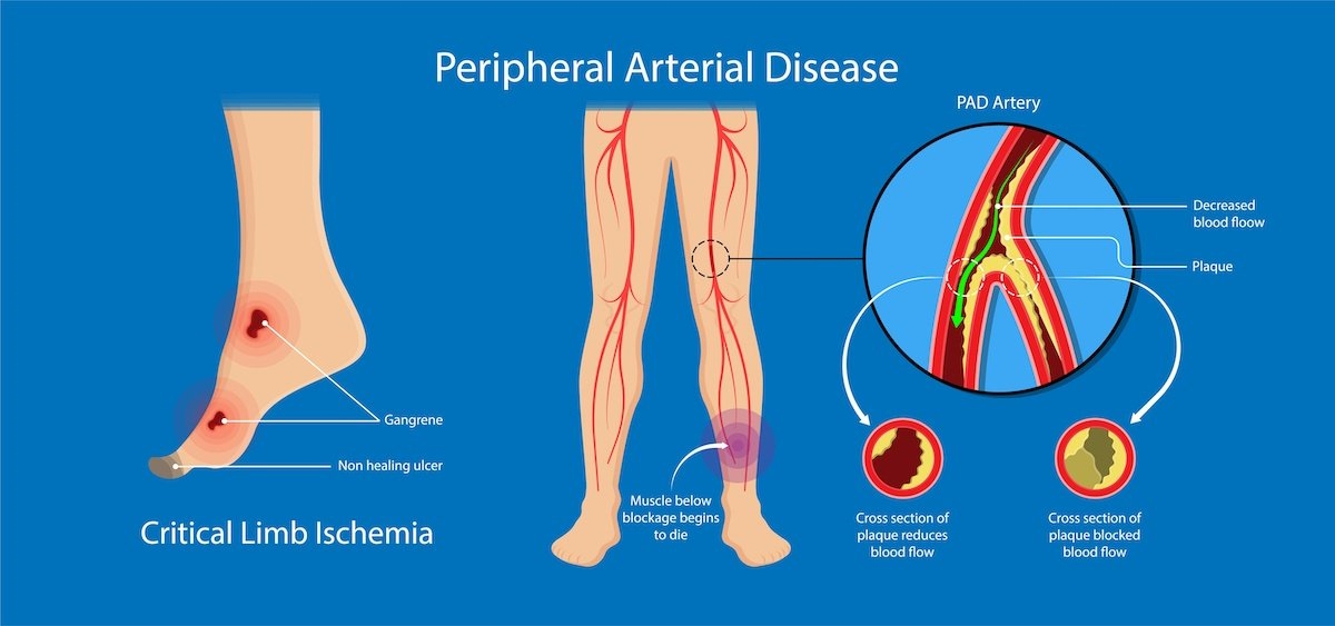 peripheral artery disease Illustration PAD