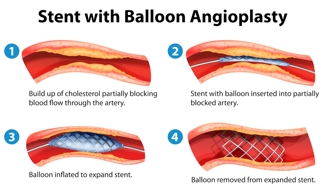 peripheral artery disease Illustration angioplasty and stenting