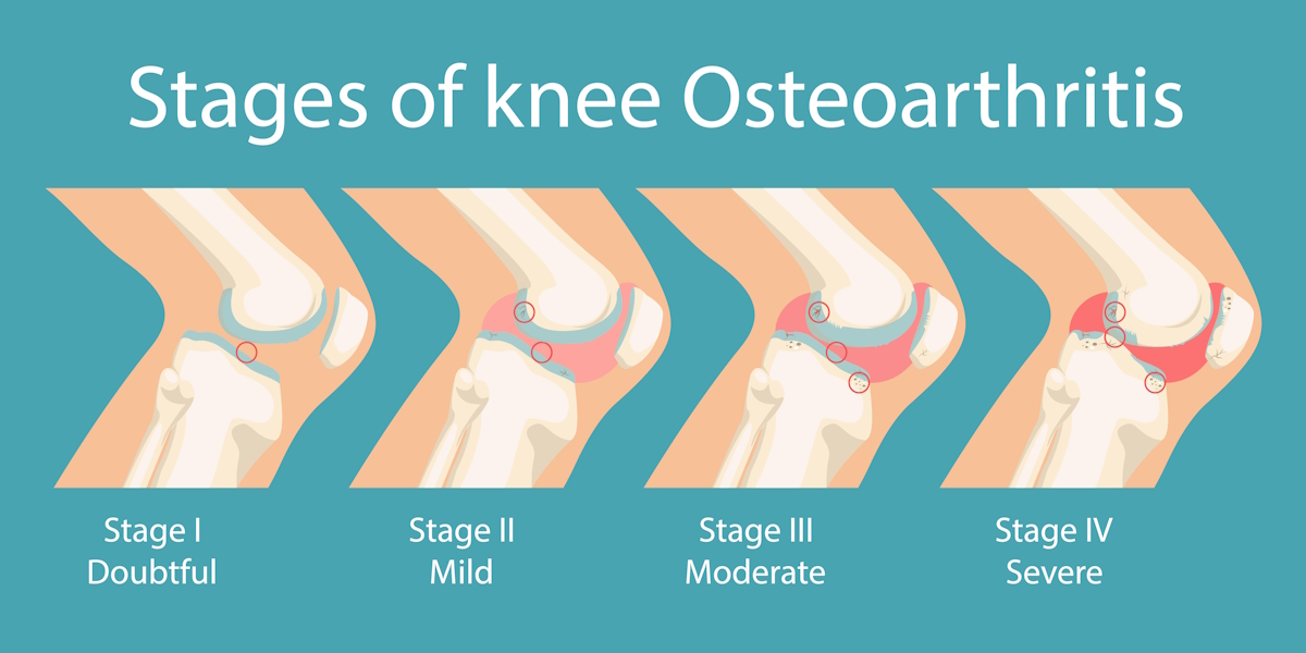 osteoarthritis knee pain illustration stages of knee osteoarthritis