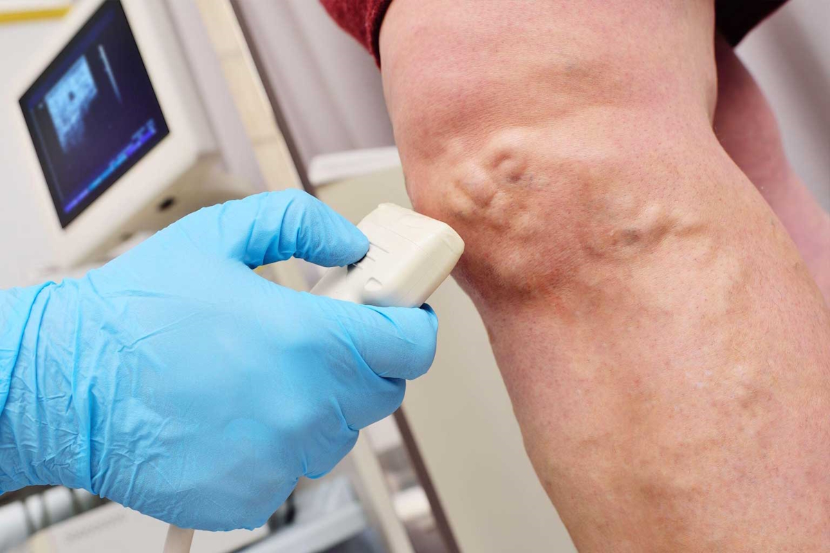 vein screening scan vascular surgeon ultrasound patient veins