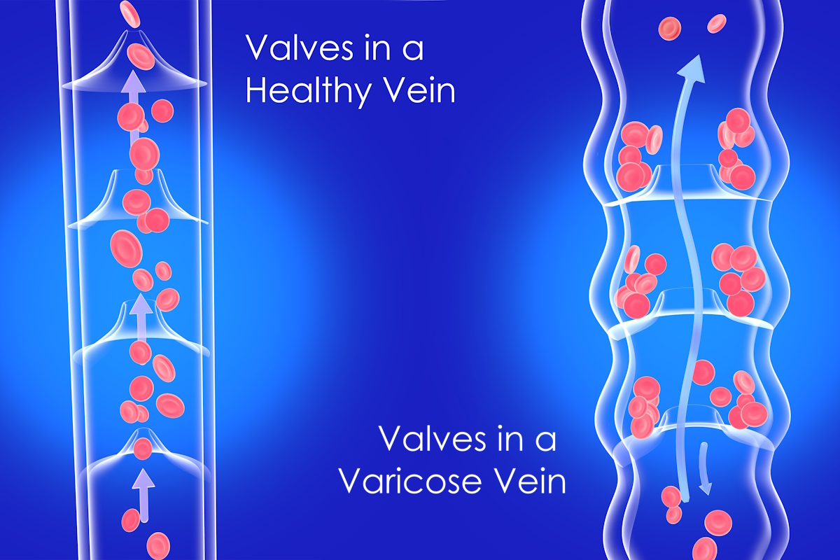 Burst Vein in Your Leg or Foot? Here’s What To Do