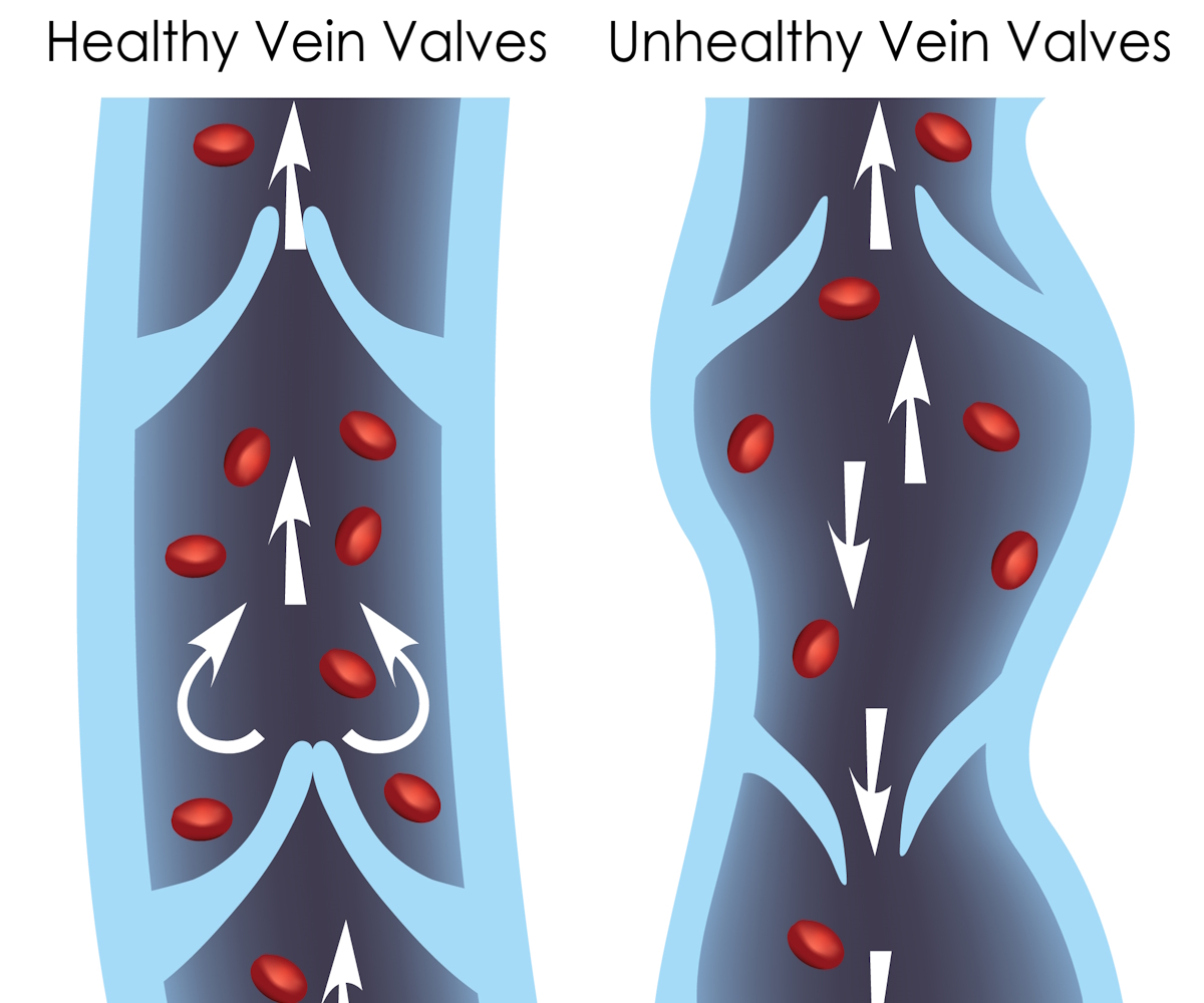 Itchy Spider Veins: Why Do My Veins Itch?